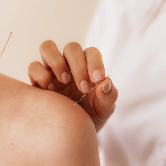 Acupuncturist Putting Needles on the Shoulder of a Person